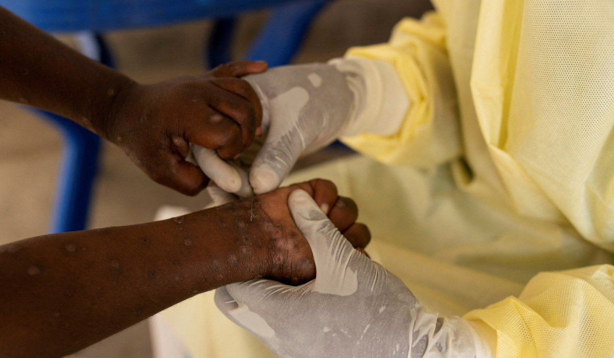 Christian Musema, a laboratory nurse, takes a sample from a child declared a suspected case of Mpox at the treatment centre in Munigi, following Mpox cases in Nyiragongo territory near Goma, North Kivu province, Democratic Republic of the Congo July 19, 2024. (REUTERS)