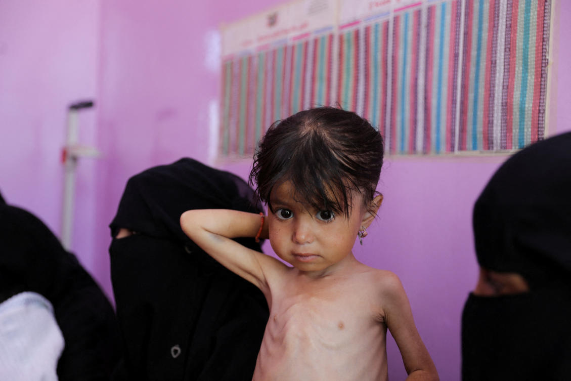 A malnourished girl waits at a measurement room of a hospital as Yemeni children face the risk of medical complications amid high levels of food insecurity, in Sanaa. (File/Reuters)