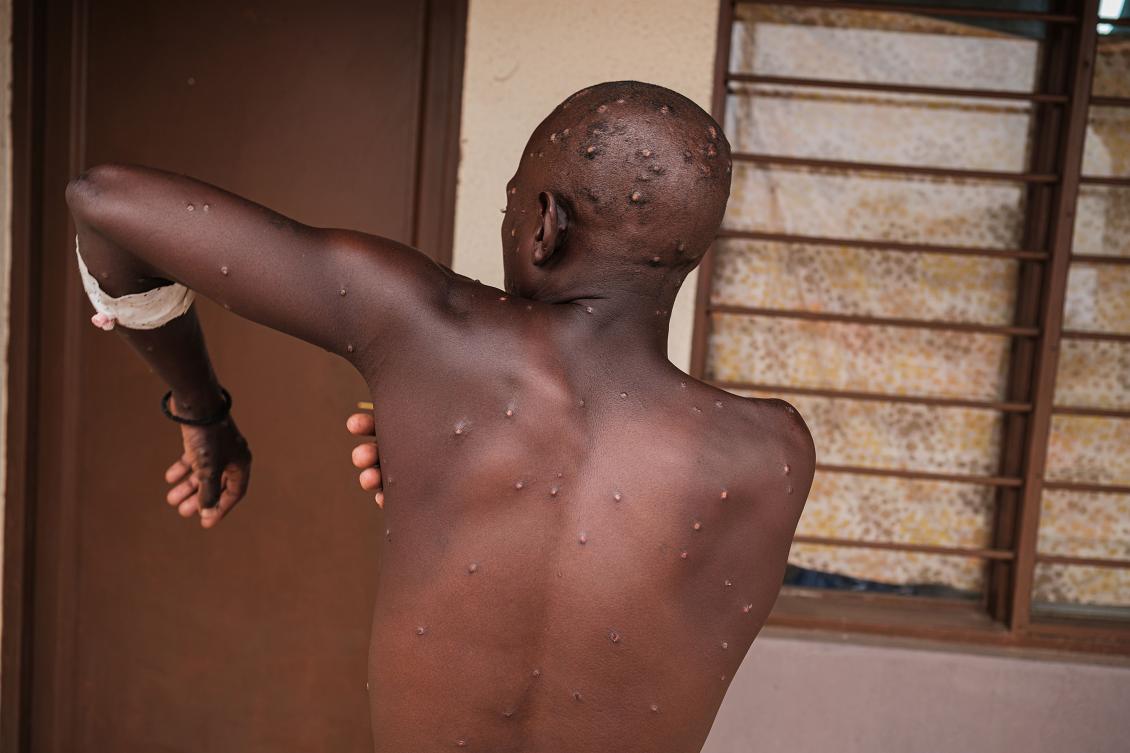 Mpox patient Nduwimana Samuel (28) reacts at the Kamenge University Hospital’s Mpox treatment center in Bujumbura on August 22, 2024.(AFP)