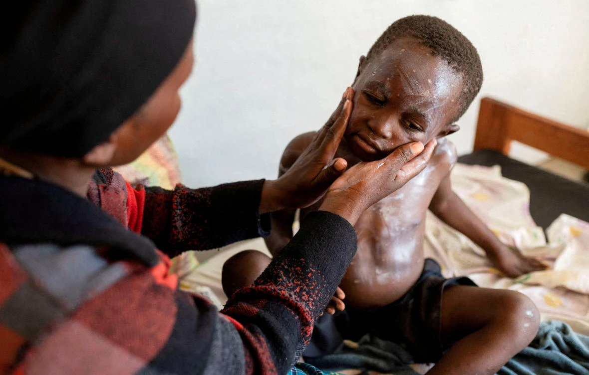 Furaha Elisabeth applies medication on the skin of her child Sagesse Hakizimana who is under treatment against Mpox, an infectious disease caused by the Mpox virus that causes a painful rash, enlarged lymph nodes and fever, at a health center in Congo (REUTERS)