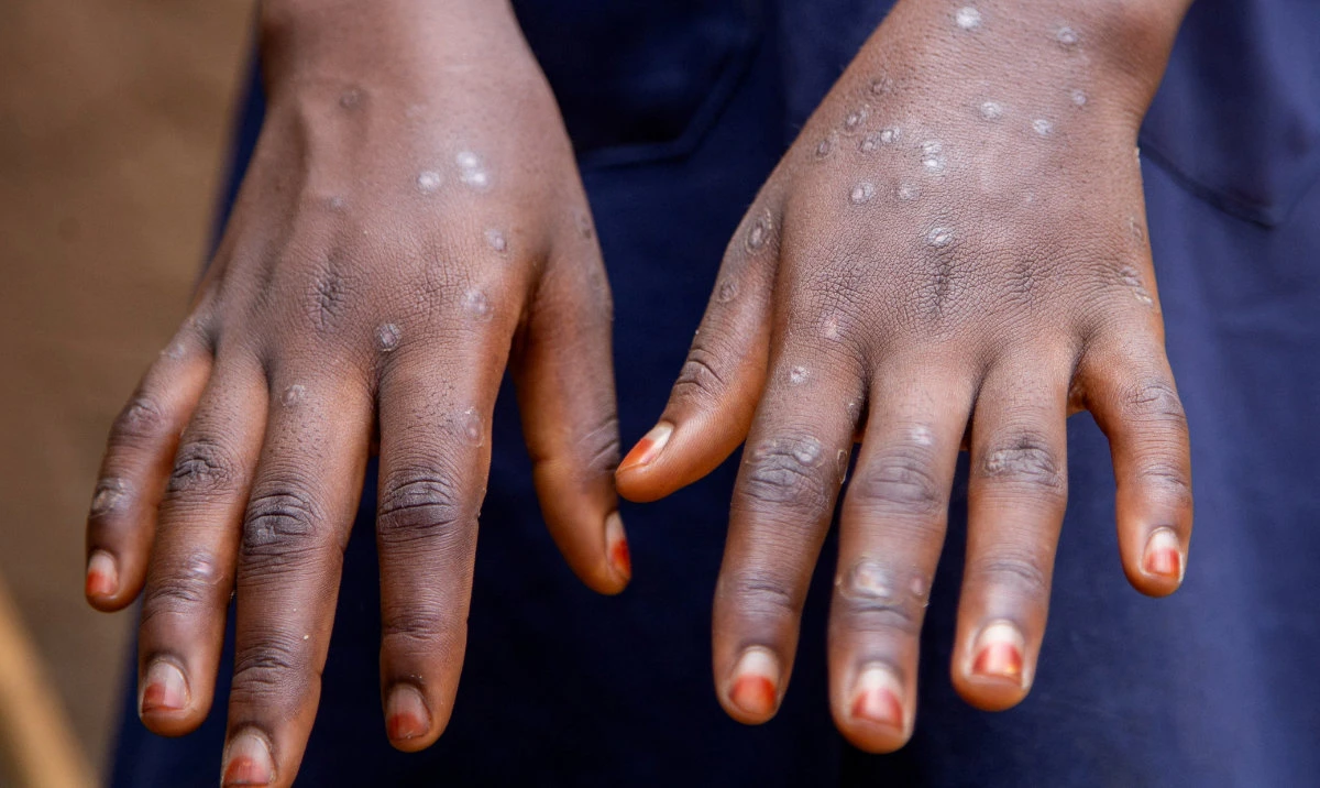 Sumaya Hatungimana, 12, shows the marks on her hands after recovering from Mpox, outside her house in Kinama zone, in Bujumbura, Burundi, August 28, 2024. (Reuters)