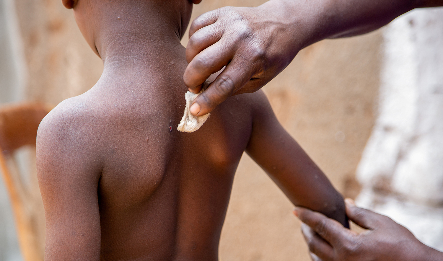 Omar Kagoma shows the marks on the skin of his six-year-old son Moussa Niyonkuru, after he recovered from Mpox, outside their house in Kinama zone, in Bujumbura, Burundi, August 28, 2024. (REUTERS)