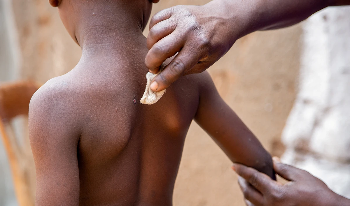 Omar Kagoma shows the marks on the skin of his six-year-old son Moussa Niyonkuru, after he recovered from Mpox, outside their house in Kinama zone, in Bujumbura, Burundi, August 28, 2024. (REUTERS)