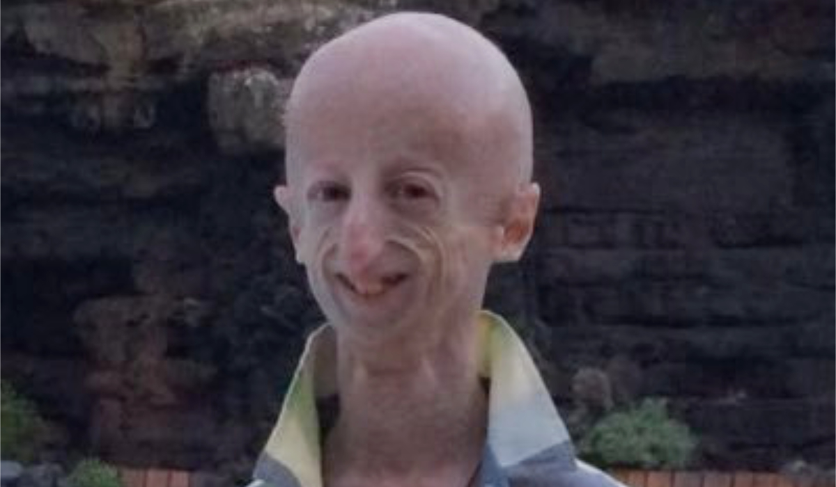 Survivor of rare rapid-aging disease progeria dies at 28