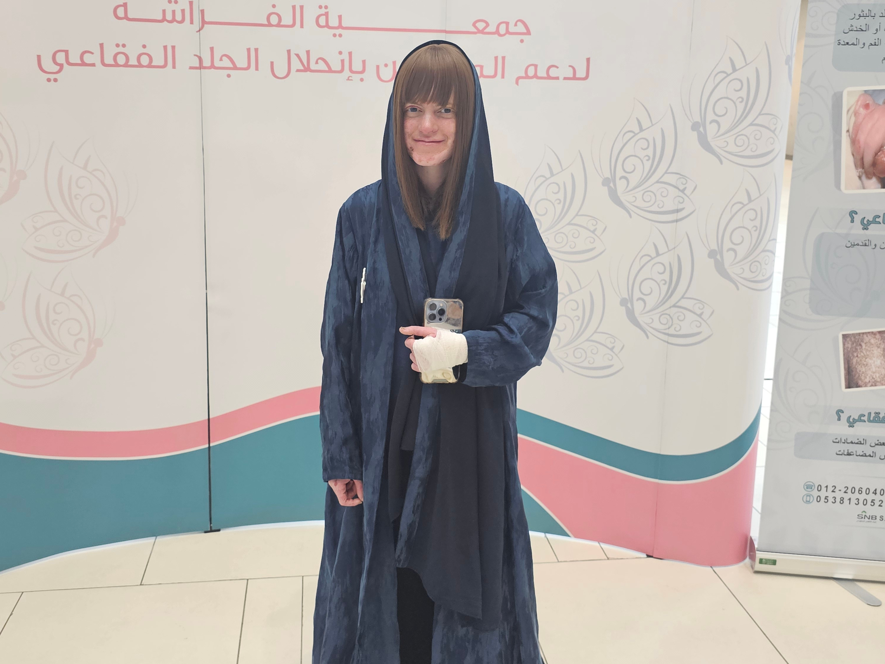 Abrar Al-Othman, who was born with epidermolysis bullosa that causes painful blisters from even minimal contact, has written three books about the disease. (Supplied)