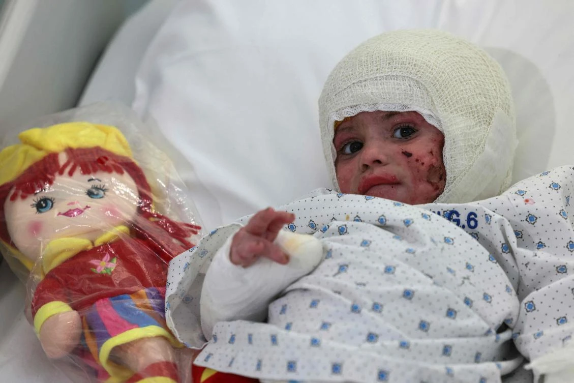Two-year-old Ivana Skayki who suffered burns from an Israeli strike in southern Lebanon, rests in bed at Geitaoui Hospital in Beirut on October 30, 2024. (AFP)