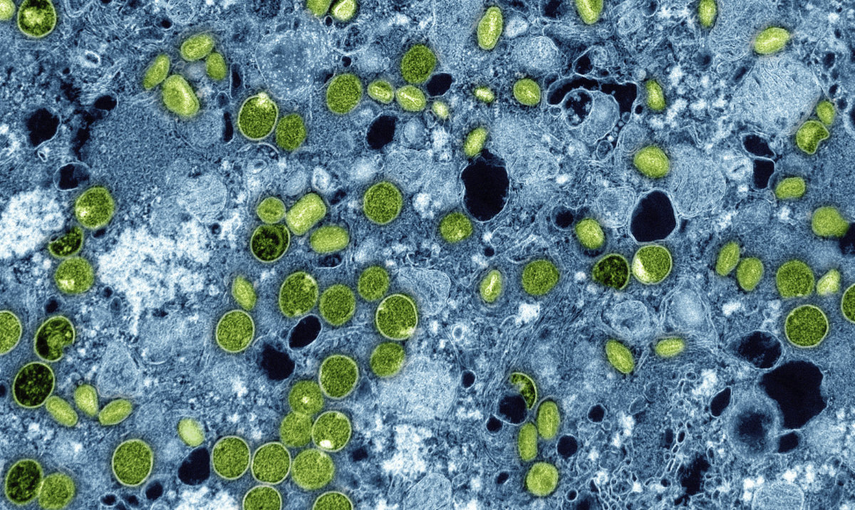 UK identifies 4 cases of new mpox variant, the first cluster outside Africa