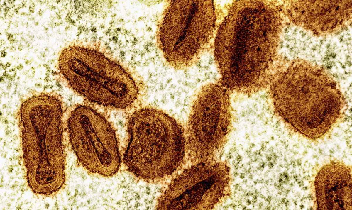 US health officials report 1st case of new form of mpox in a traveler