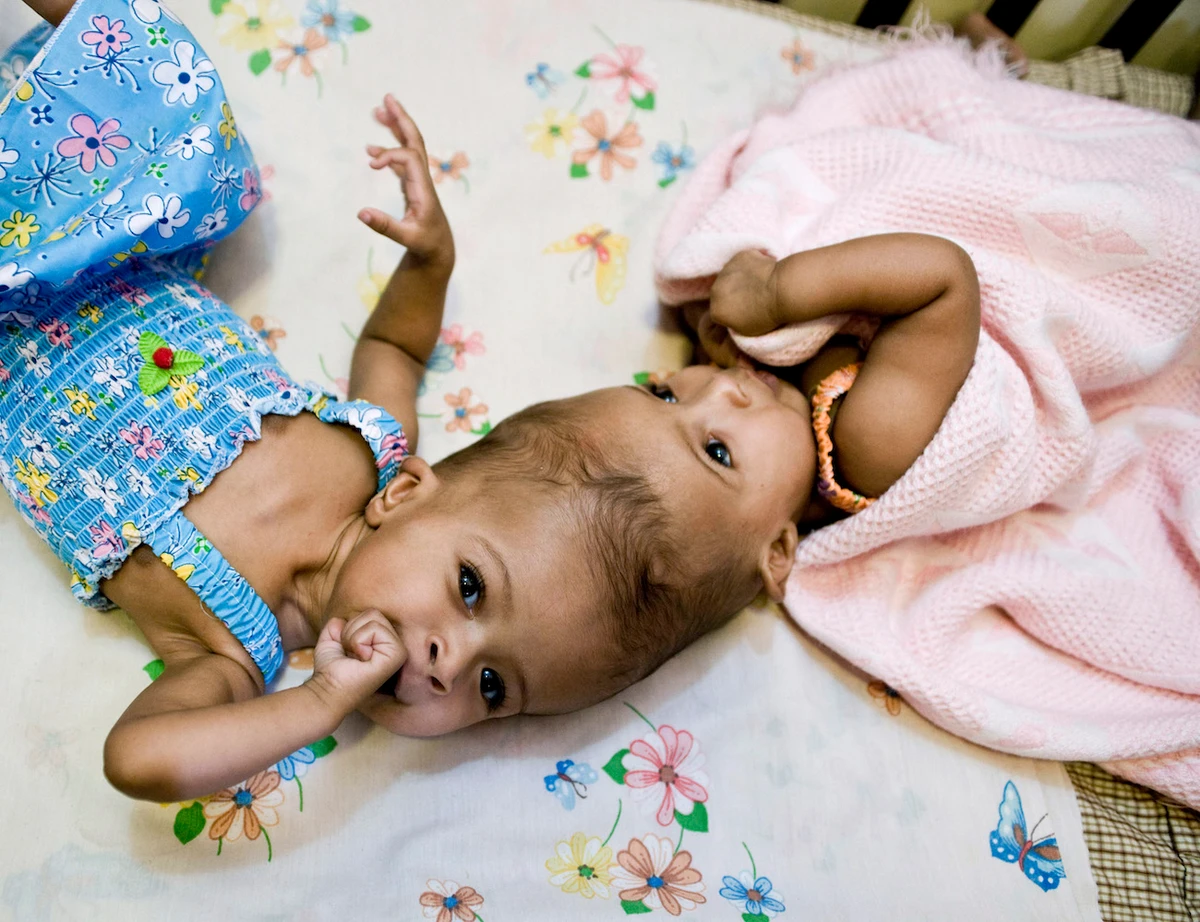 Baby girls Rital and Ritag Gaboura, two craniopagus twins, lie on a bed at the world famous Great Ormond Street Hospital in London. (File/AFP)