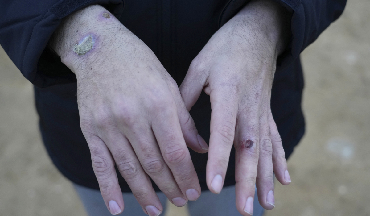 A freed Palestinian prisoner shows wounds on his hands on arrival to the Gaza Strip after being released from an Israeli prison following a ceasefire agreement between Hamas and Israel in Khan Younis, Gaza Strip, Thursday, Feb. 27, 2025. (AP)