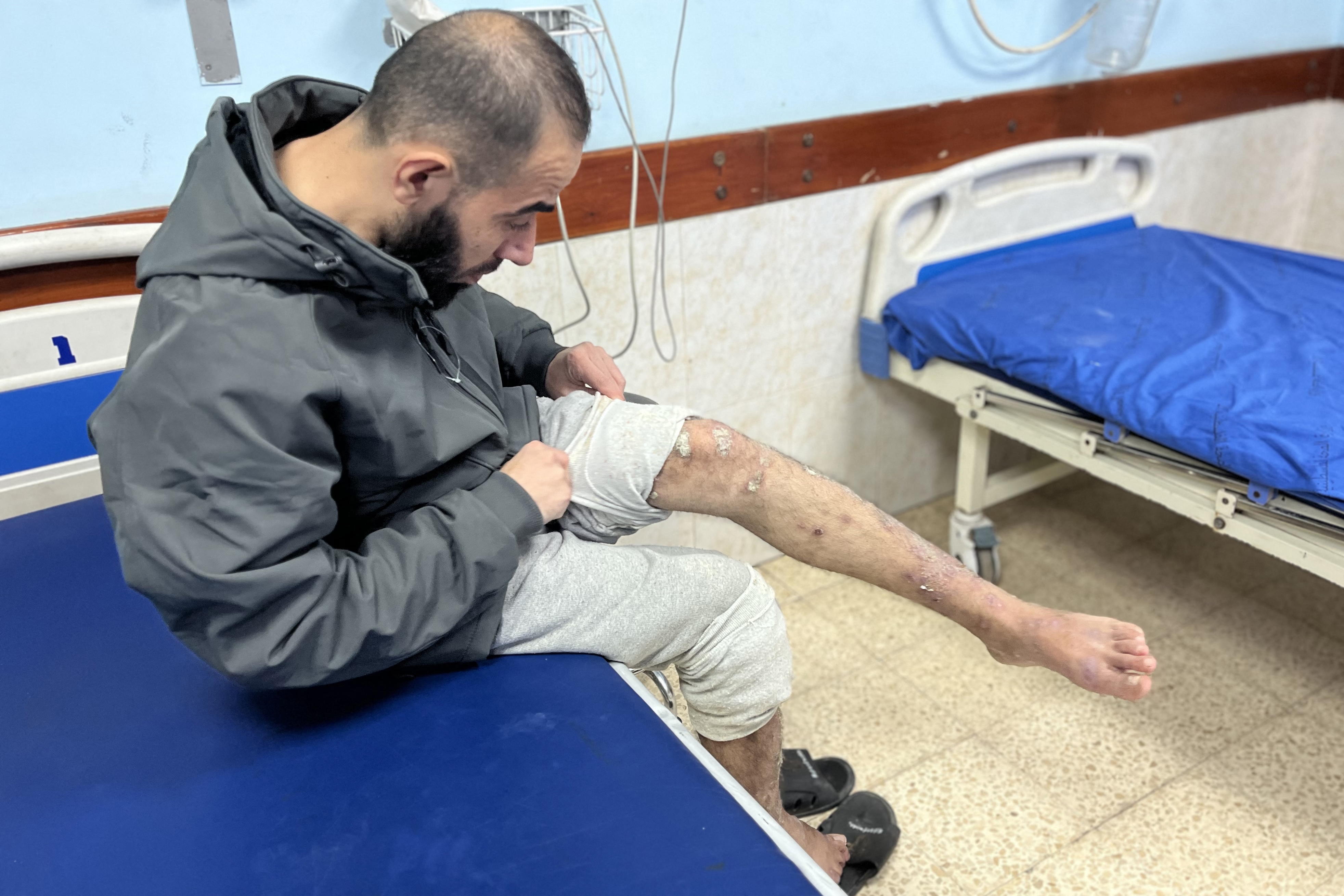 A Palestinian prisoner looks at his leg as he awaits treatment at the European Hospital in Khan Yunis in the southern Gaza Strip following his release by Israeli authorities, Feb. 27, 2025. (AFP)