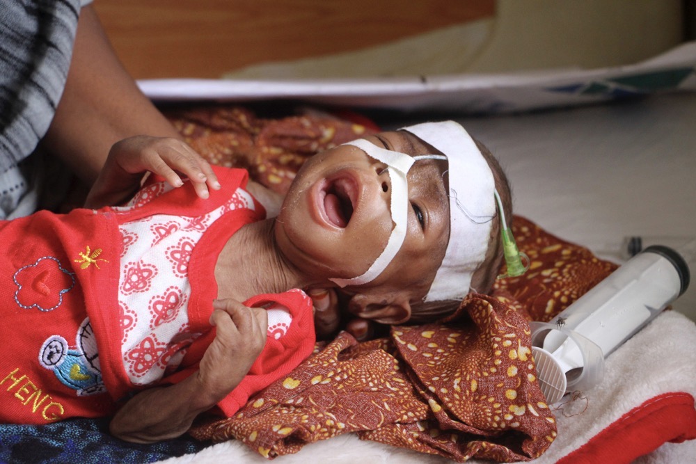 A malnourished child receives treatment at Banadir Hospital in Mogadishu, Somalia. (AP)