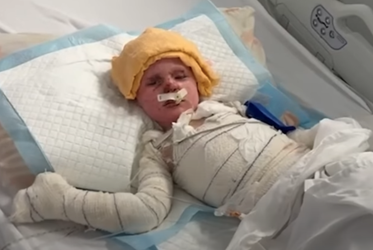 Doctors fear Haitham, 3, may not survive after he was severely burned in an Israeli airstrike that killed his parents. (Screengrab)