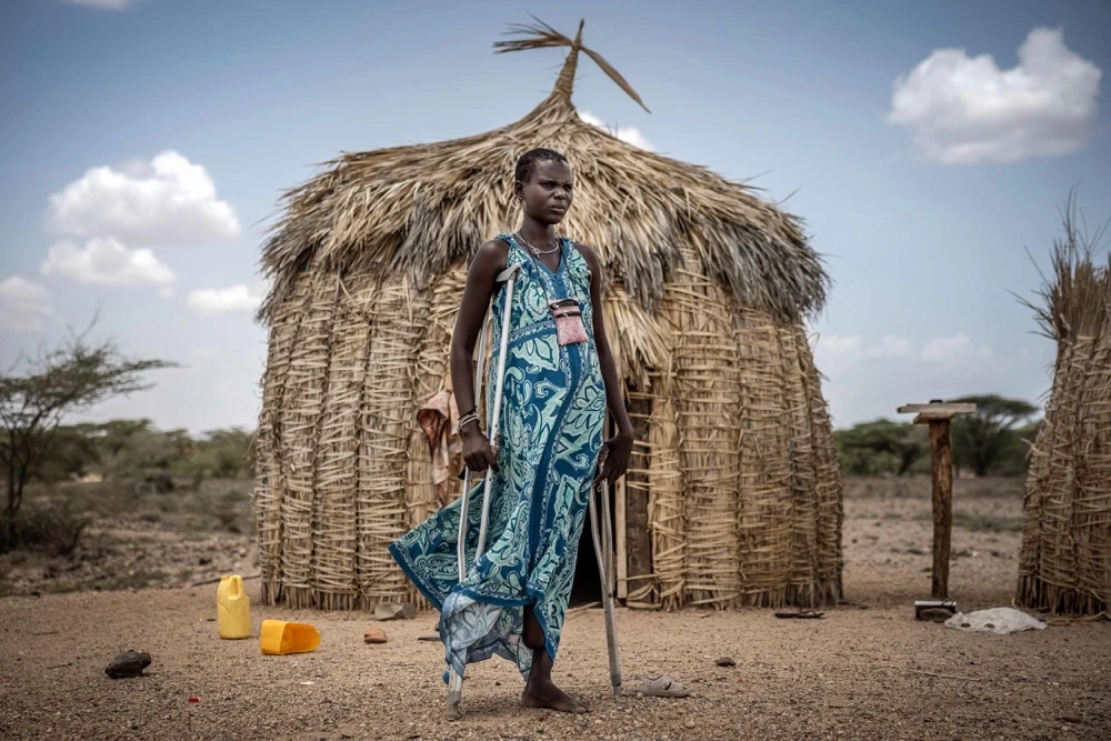 ycetoma patient Joyce Loote Lokonyi, 29, who had her foot amputated due to complications from the infection. (AFP)