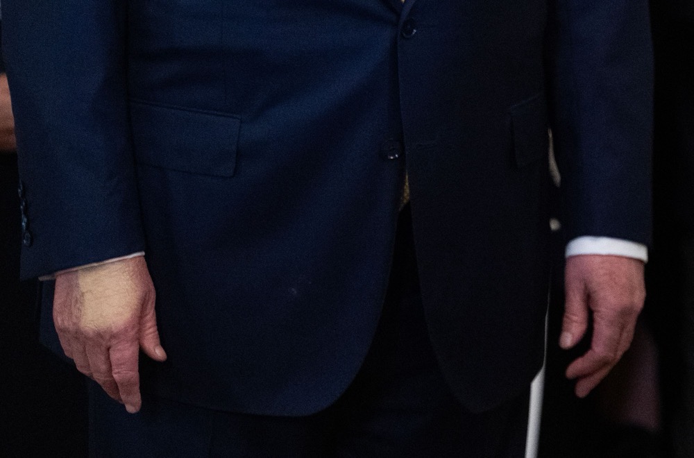 Discoloration is seen on the hand of US President Donald Trump as he attends the "Halt All Lethal Trafficking of Fentanyl Act" signing in the East Room of the White House in Washington, DC, on July 16, 2025. (AFP)