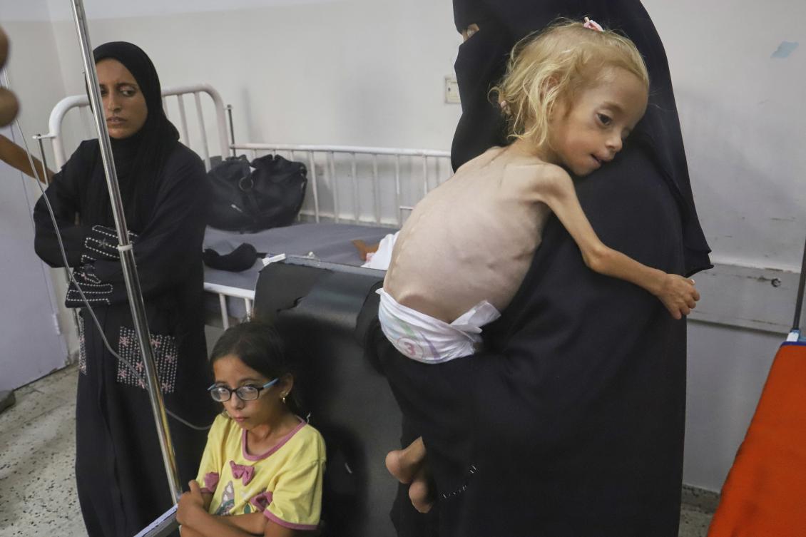Islam Qudeih shows her severely malnourished 2-year-old daughter, Shamm, to journalists at Nasser Hospital in Khan Younis, southern Gaza. (AP)