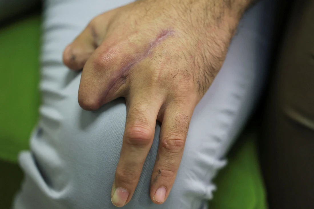 Mohammed Nasser al Din, a victim of the pager attack, sits in a room with some fingers missing, in Beirut, Lebanon. (Reuters)