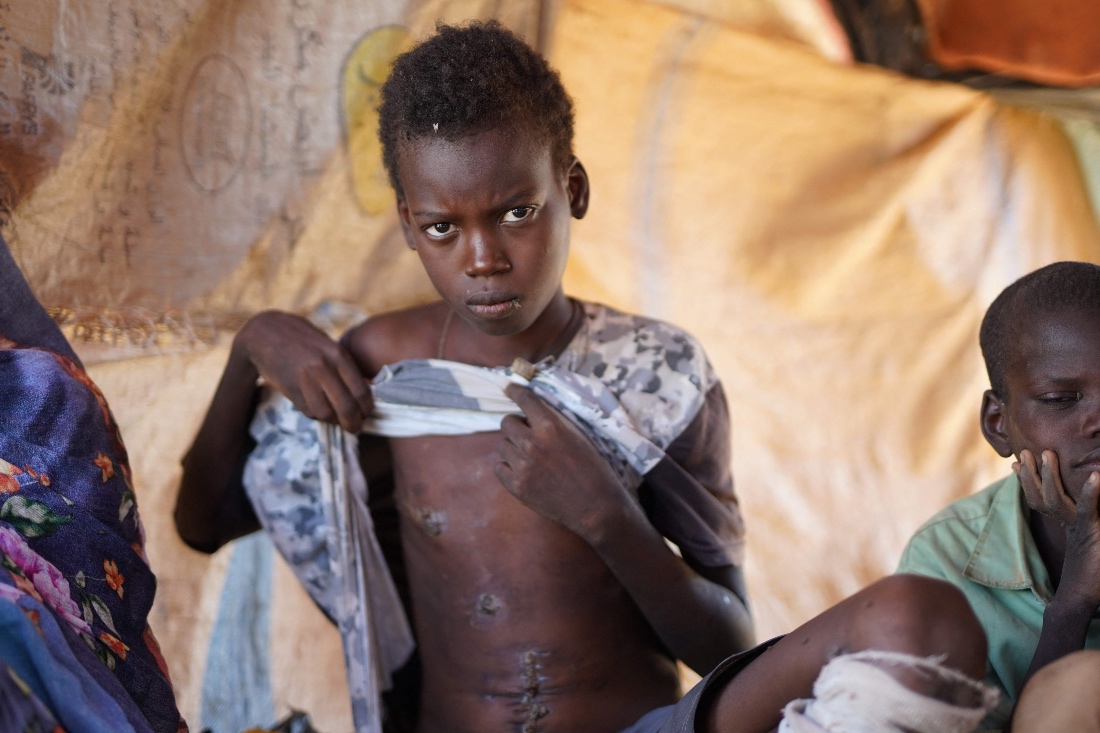 Ibrahim Ismail, who was wounded in an attack on a local market in El-Fasher, showing his scars at a makeshift camp in the city of Tawila sheltering displaced civilians who have fled violence in El-Fasher. (AFP)