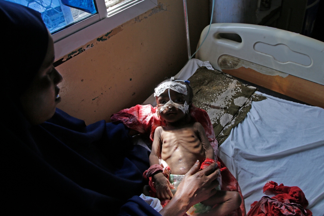 A mother sits with her malnourished baby at Banadir Hospital in Mogadishu, Somalia. (AP)