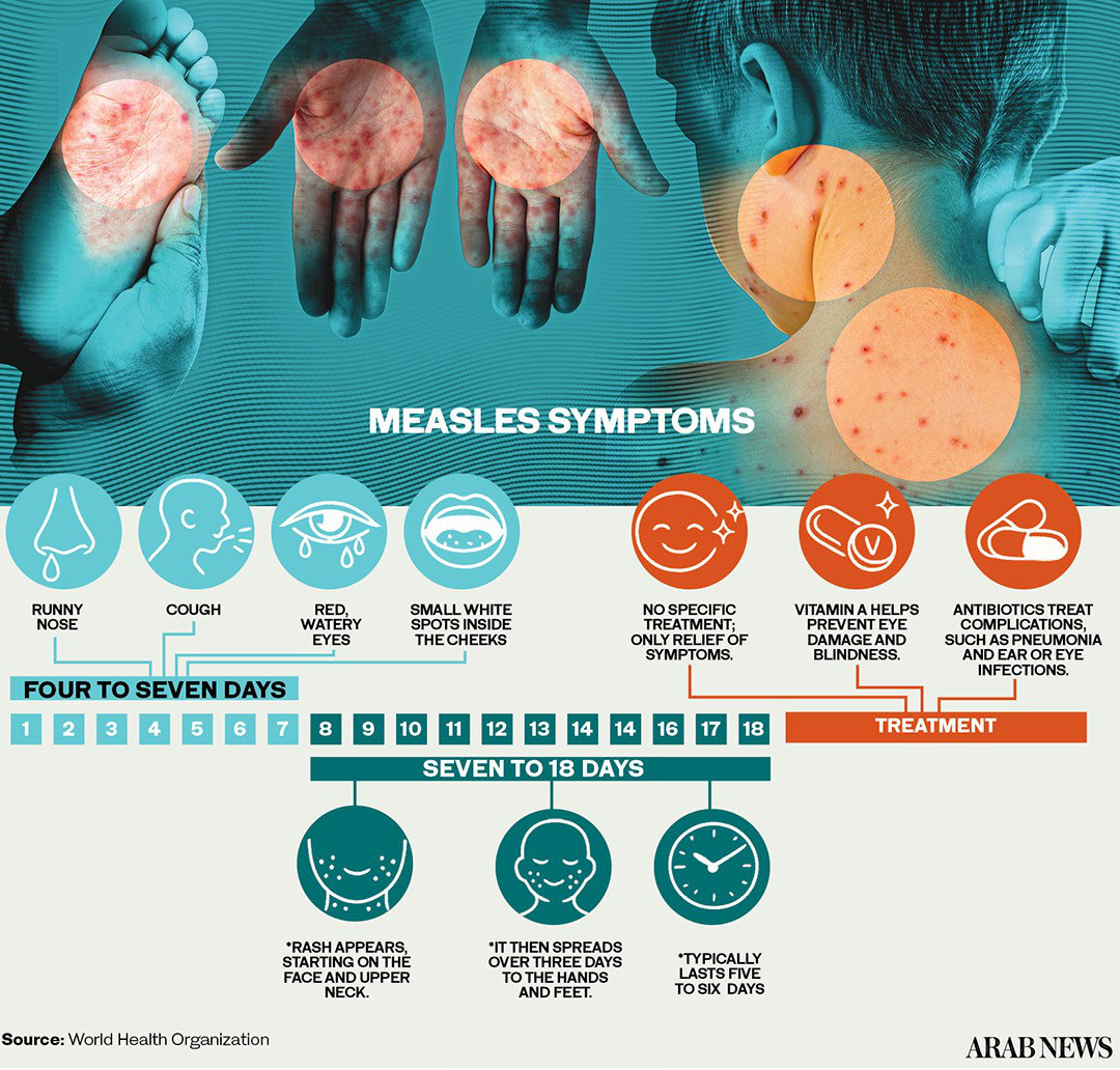How conflict is driving measles outbreaks in the Middle East and North Africa