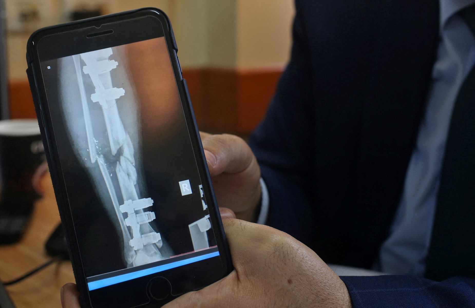 A Palestinian doctor displays a digital X-ray at Al-Shefa hospital in Gaza showing the damage inflicted upon the leg of a patient, who was injured during mass protests along the border of the Palestinian enclave in Apr. 2018. (Files / AFP)