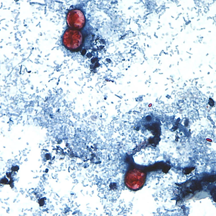 Outbreak of diarrhea-causing parasite grows to more than 1,000 cases