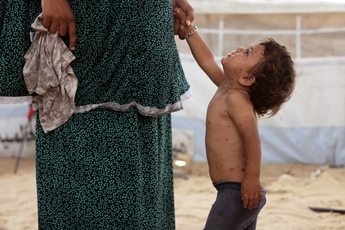 A displaced Palestinian girl, who according to doctors is suffering from chickenpox, stands next to her mother in Khan Younis, in the southern Gaza Strip, on July 19, 2026. (AFP)