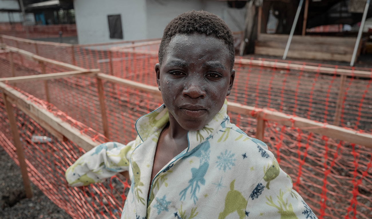 Prince Bahati, who is infected with Mpox, looks towards the camera at the Mpox treatment centre at the Nyiragongo general reference hospital, north of the city of Goma in the Democratic Republic of Congo, on August 16, 2024. (AFP/File)