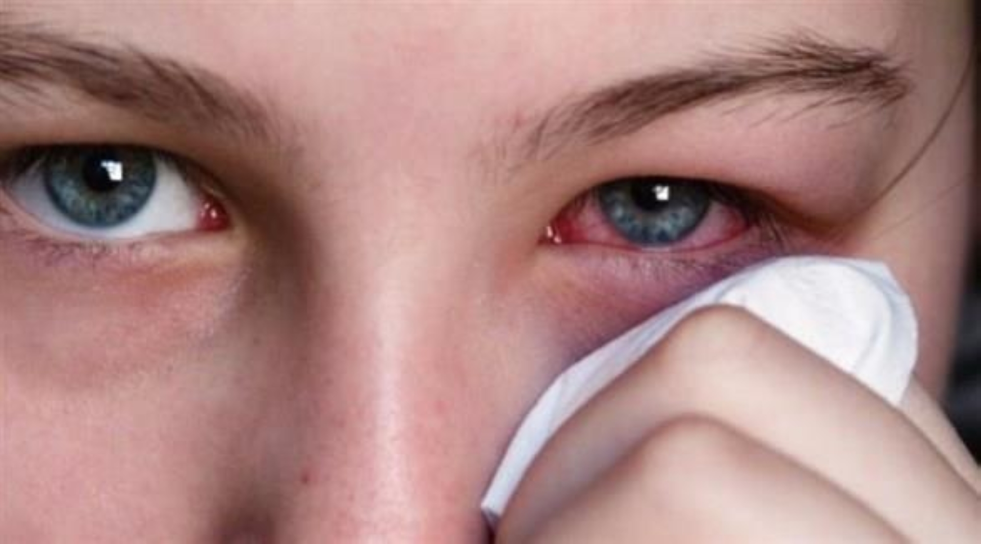 منها زيادة الدموع.. أعراض وأسباب حساسية العين خلال الصيف