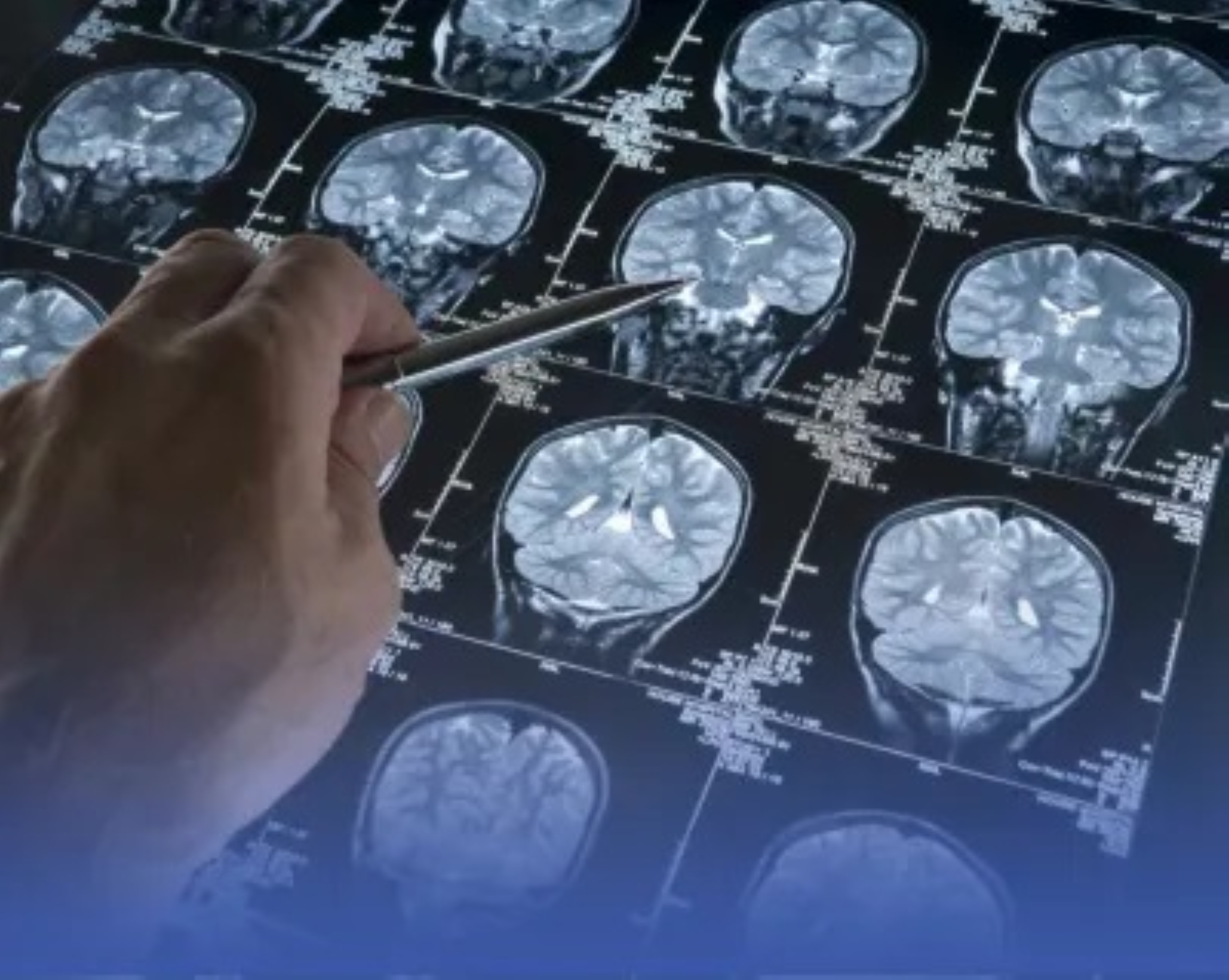 دراسة: التحدث بلغتين يؤخر الزهايمر 5 سنوات