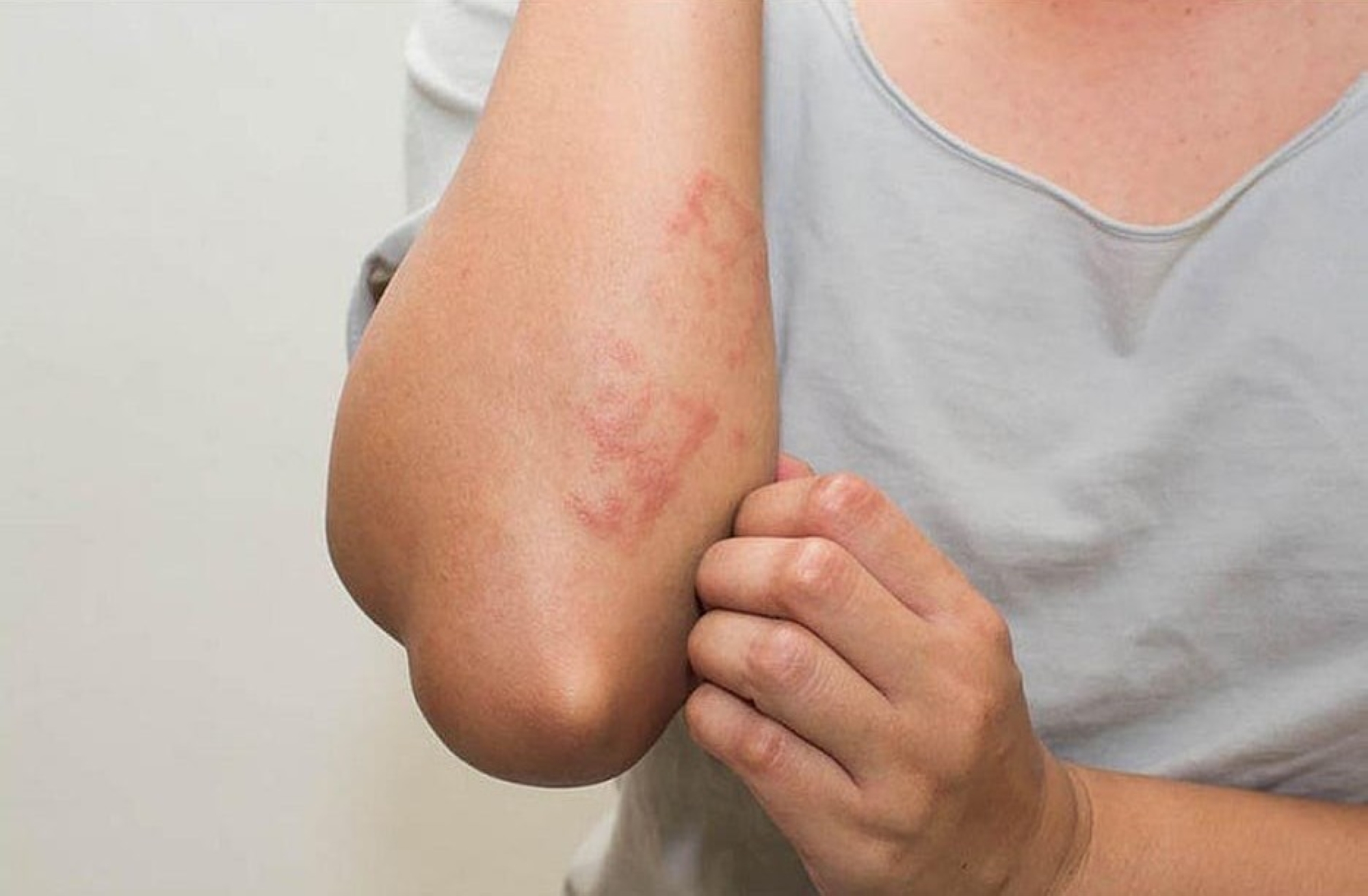 موافقة أمريكية على "دوبيكسينت" لعلاج الأمراض الجلدية