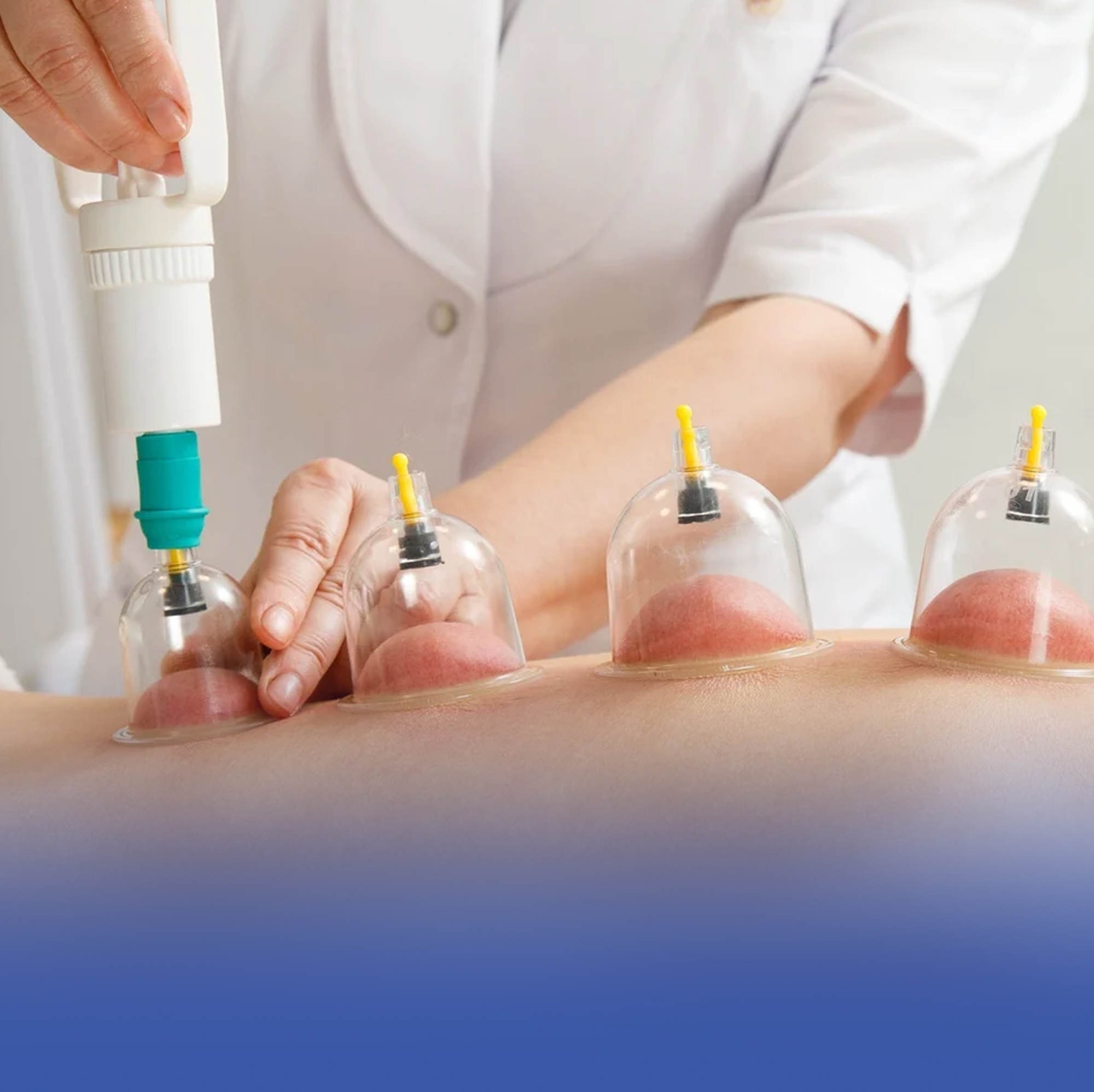 "الطب البديل" يحذر من استخدام العسل في الحجامة
