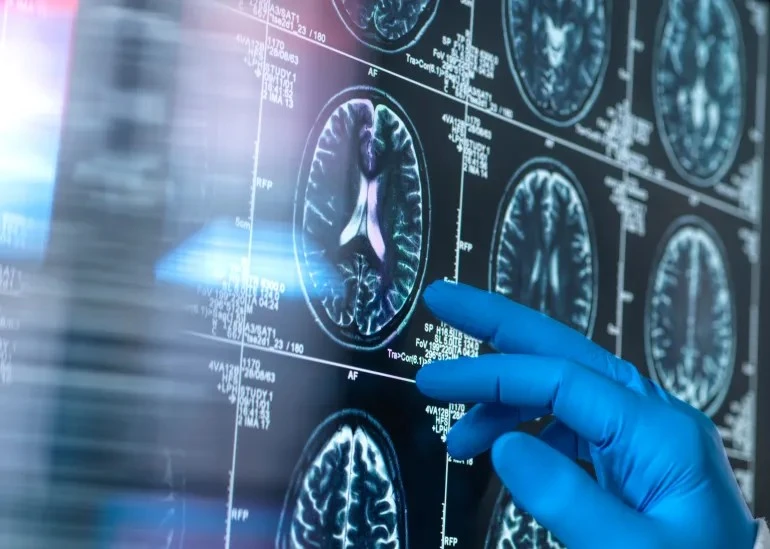 بحث أمريكي يربط الإشعاع بزيادة احتمالات الخرف