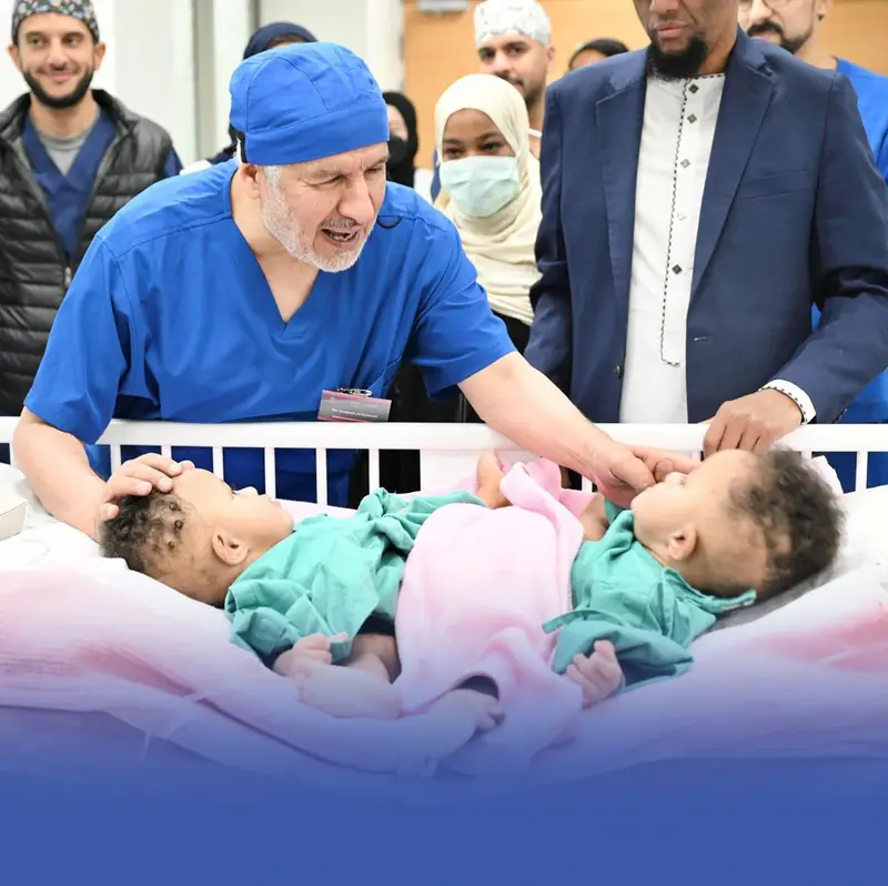 انتهاء عملية فصل التوأم السيامي الصومالي "رحمة ورملا"