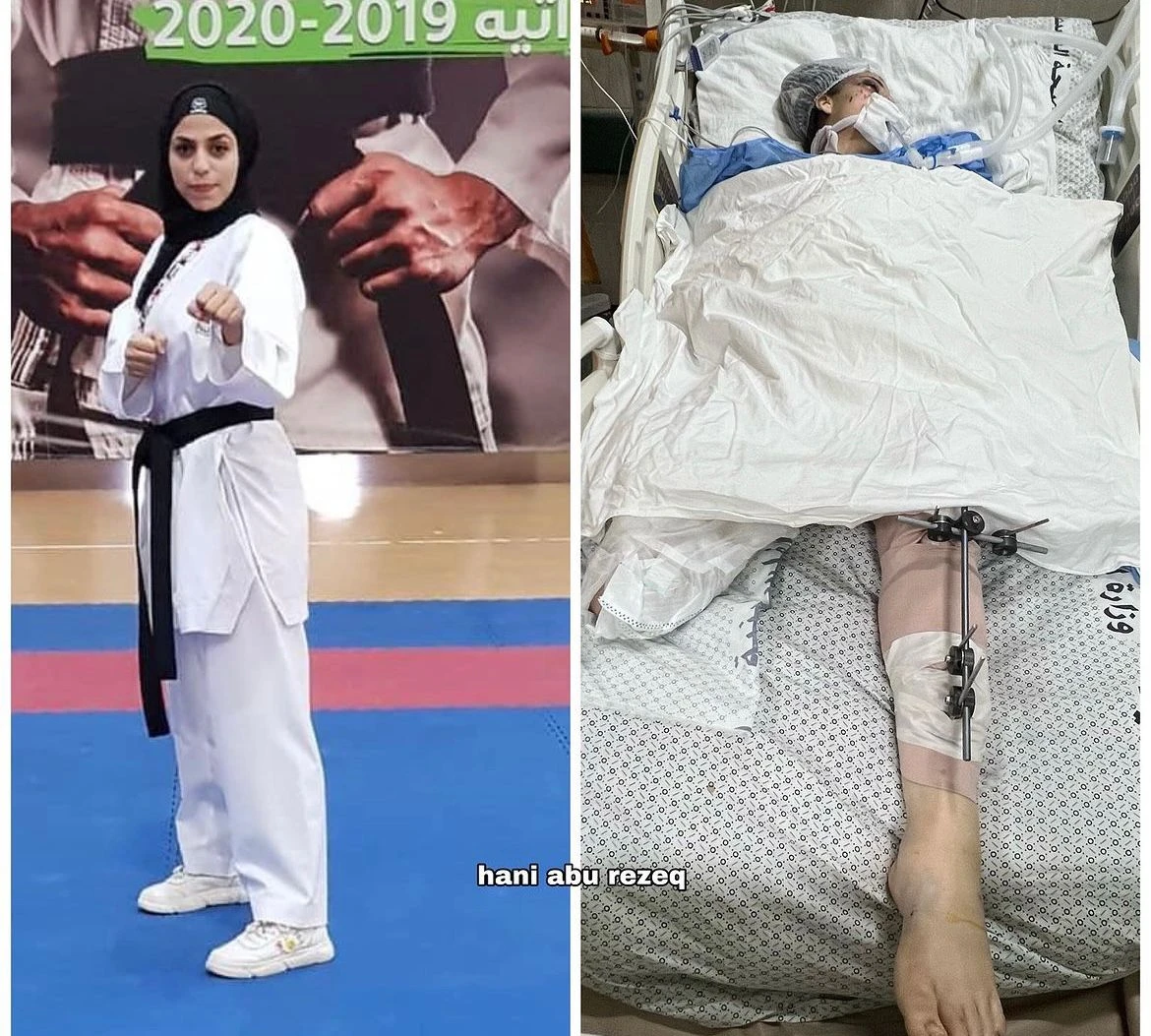‘Most beautiful karate player’: Gaza female athlete dies after losing leg due to Israeli airstrike