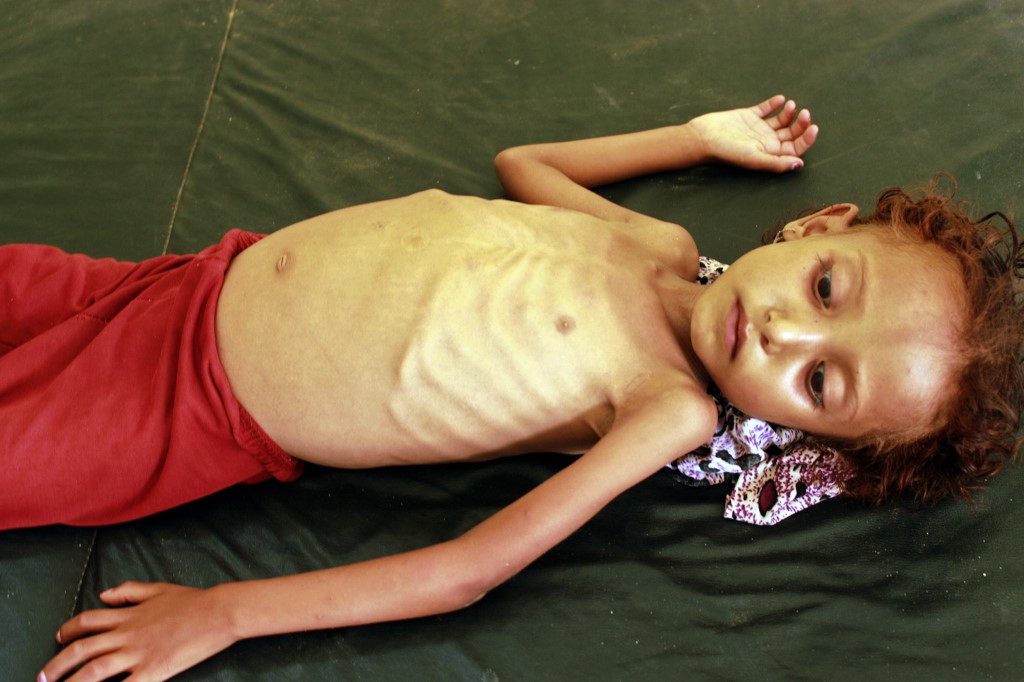 un enfant touché par le fléau de la malnutrition. (AFP)