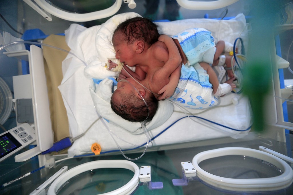 Des jumeaux siamois nouveau-nés gisent dans un incubateur de l'unité de soins intensifs pour enfants de l'hôpital al-Sabeen de Sanaa, la capitale du Yémen, le 18 décembre 2020. (AFP)