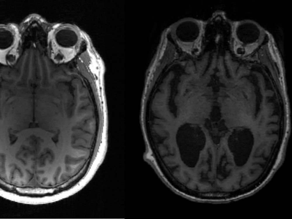 La cause de la progression de la maladie d'Alzheimer dans le cerveau découverte