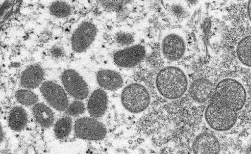 Variole du singe: Plus de 200 cas confirmés dans le monde