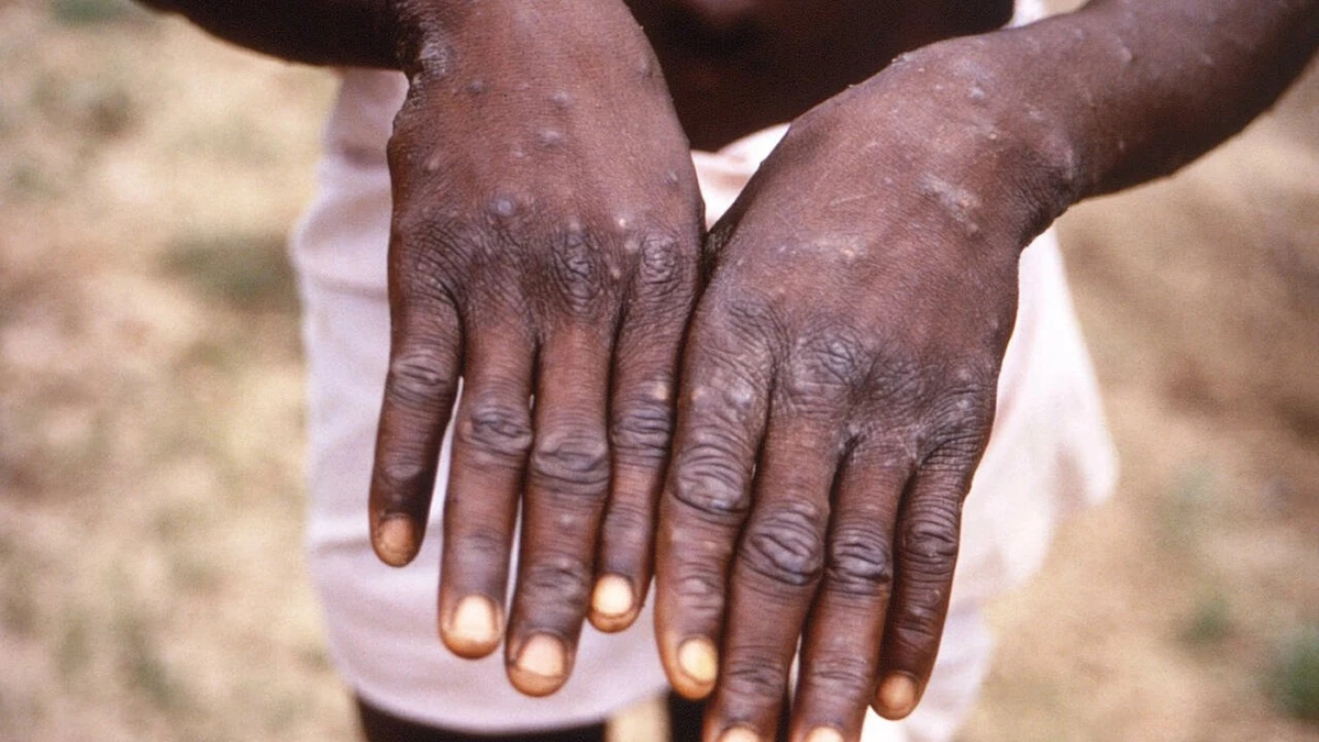 Trompeur et stigmatisant: le nom de la variole du singe devrait bientôt changer