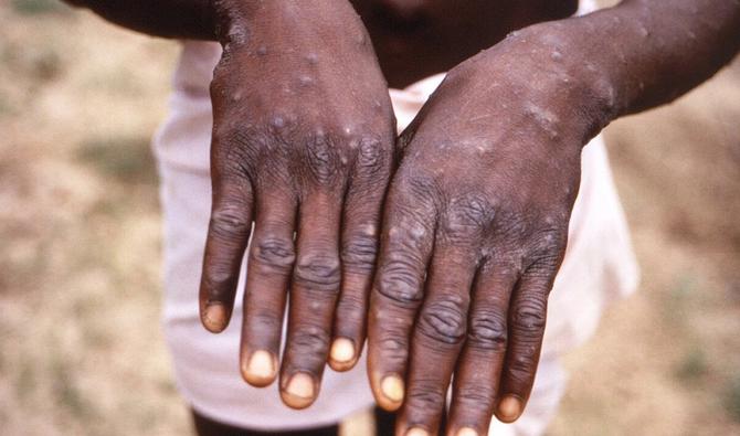 Les personnes atteintes souffrent aussi des répercussions psychologiques liées à la maladie (photo, AFP)