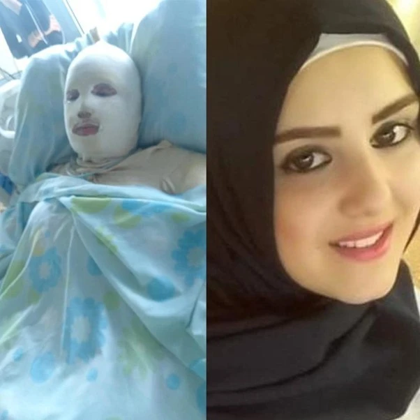 Une femme libanaise brûlée par son mari pour une grossesse non désirée