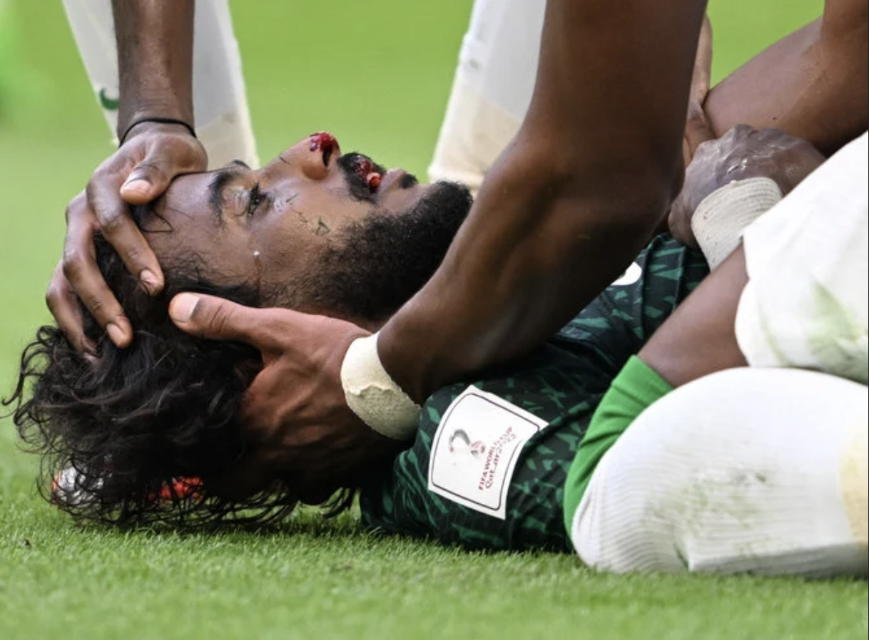 Un footballeur saoudien est opéré avec succès après sa blessure à la Coupe du monde