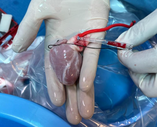 Un hôpital saoudien réalise une transplantation cardiaque sur le plus jeune patient du Moyen-Orient