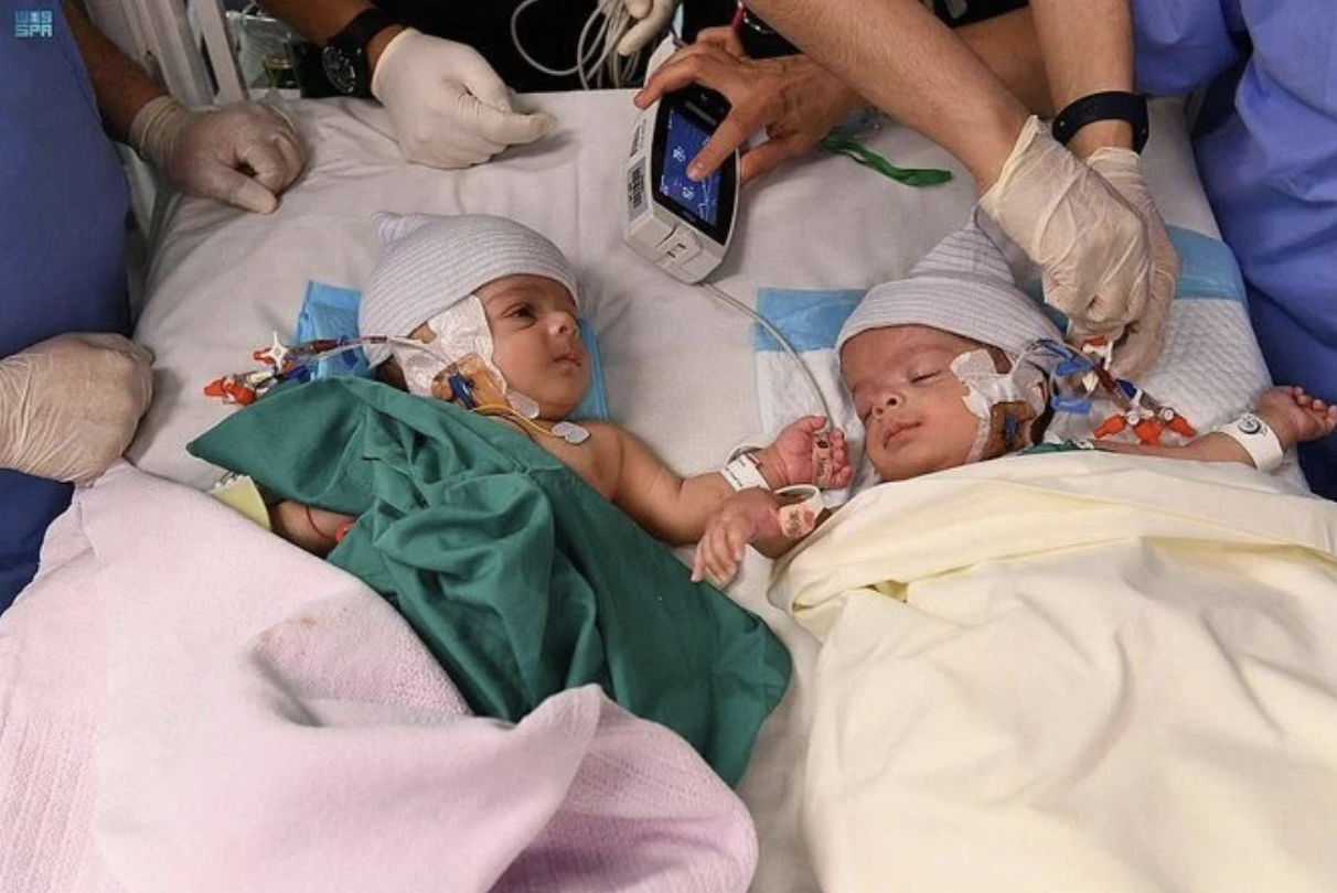 À Riyad, des chirurgiens réussissent à séparer deux frères siamois