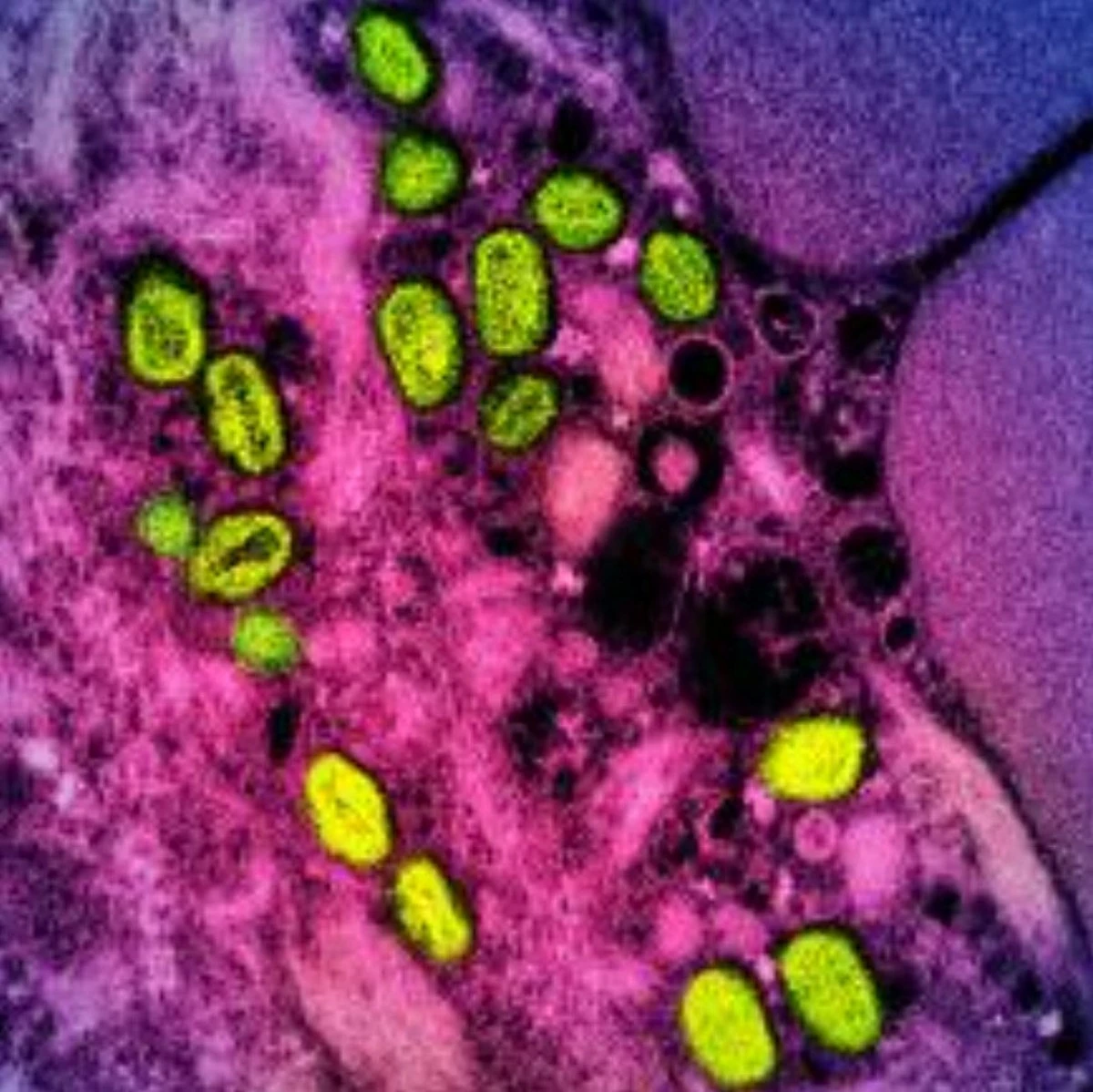 Mpox : l'OMS alerte sur le risque de cas importés en Europe