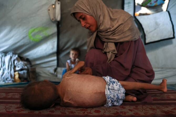 Gaza: la malnutrition touche un quart des jeunes enfants examinés par MSF la semaine dernière